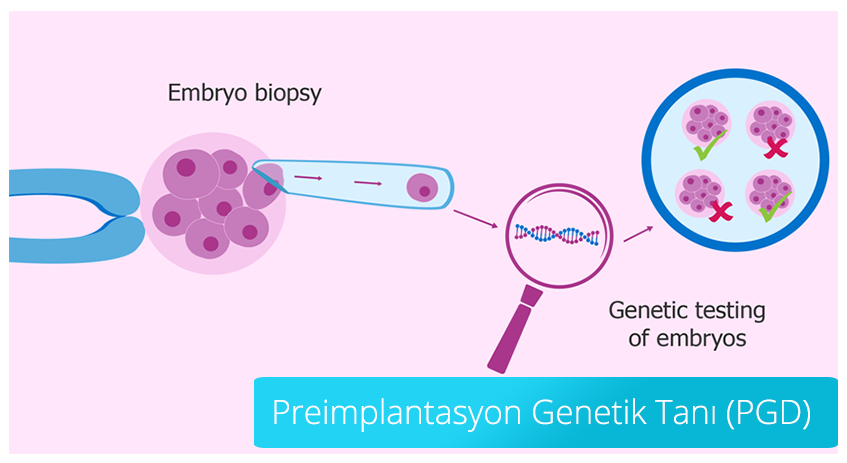 التشخيص الجيني قبل الزرع (PGD)