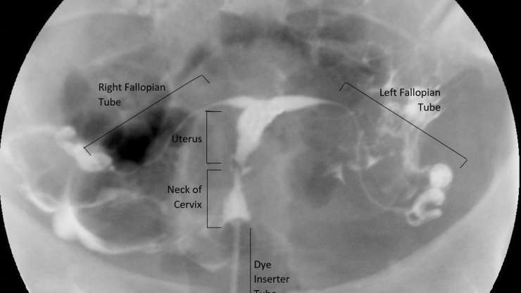 HSG (Hysterosalpingography)