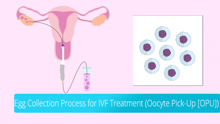 EGG COLLECTION PROCESS FOR IVF TREATMENT (OOCYTE PICK-UP [OPU])