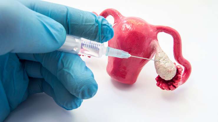 Ovarian Hyperstimulation Syndrome (OHSS) Overexcitation of the ovaries