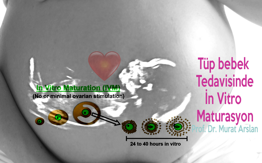 In vitro maturation in IVF Treatment