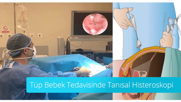 Tüp Bebek Tedavisinde Tanısal Histereskopi