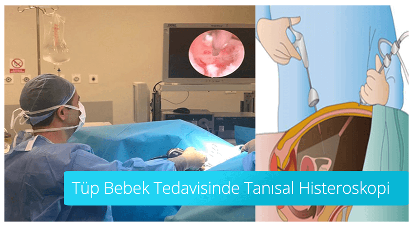 Tüp Bebek Tedavisinde Tanısal Histereskopi