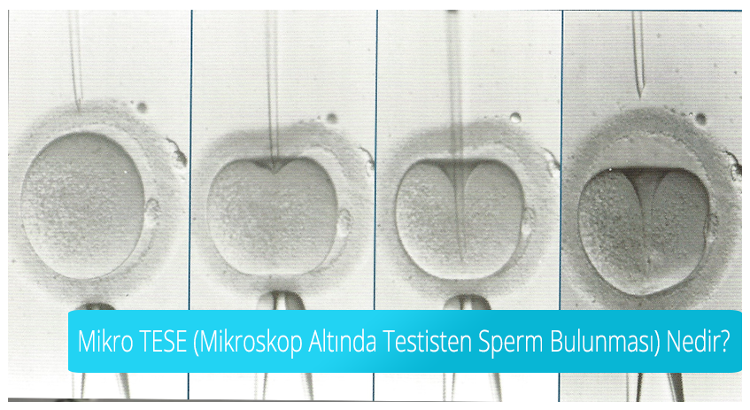 What is Micro TESE (Detection of Sperm from Testis Under Microscope)?