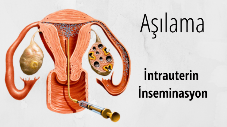 Die intrauterine Insemination (IUI)