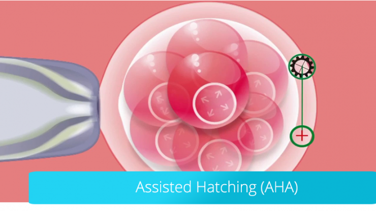 Assisted Hatching (AHA): das assistierte Schlüpfen