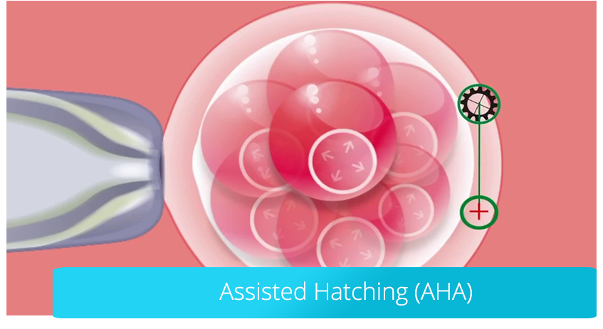 Assisted Hatching (AHA): das assistierte Schlüpfen