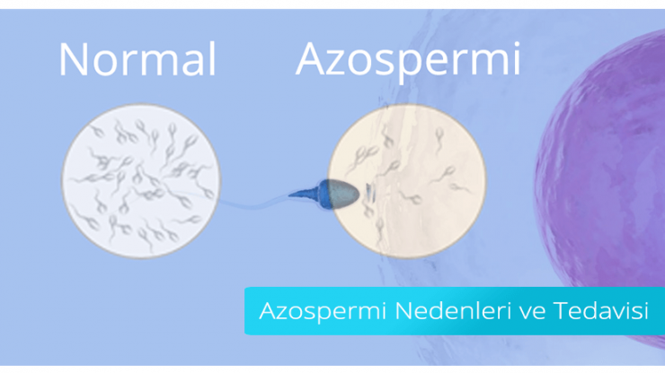 Azoospermie: Ursachen und Behandlung