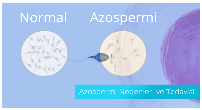 Azoospermie: Ursachen und Behandlung