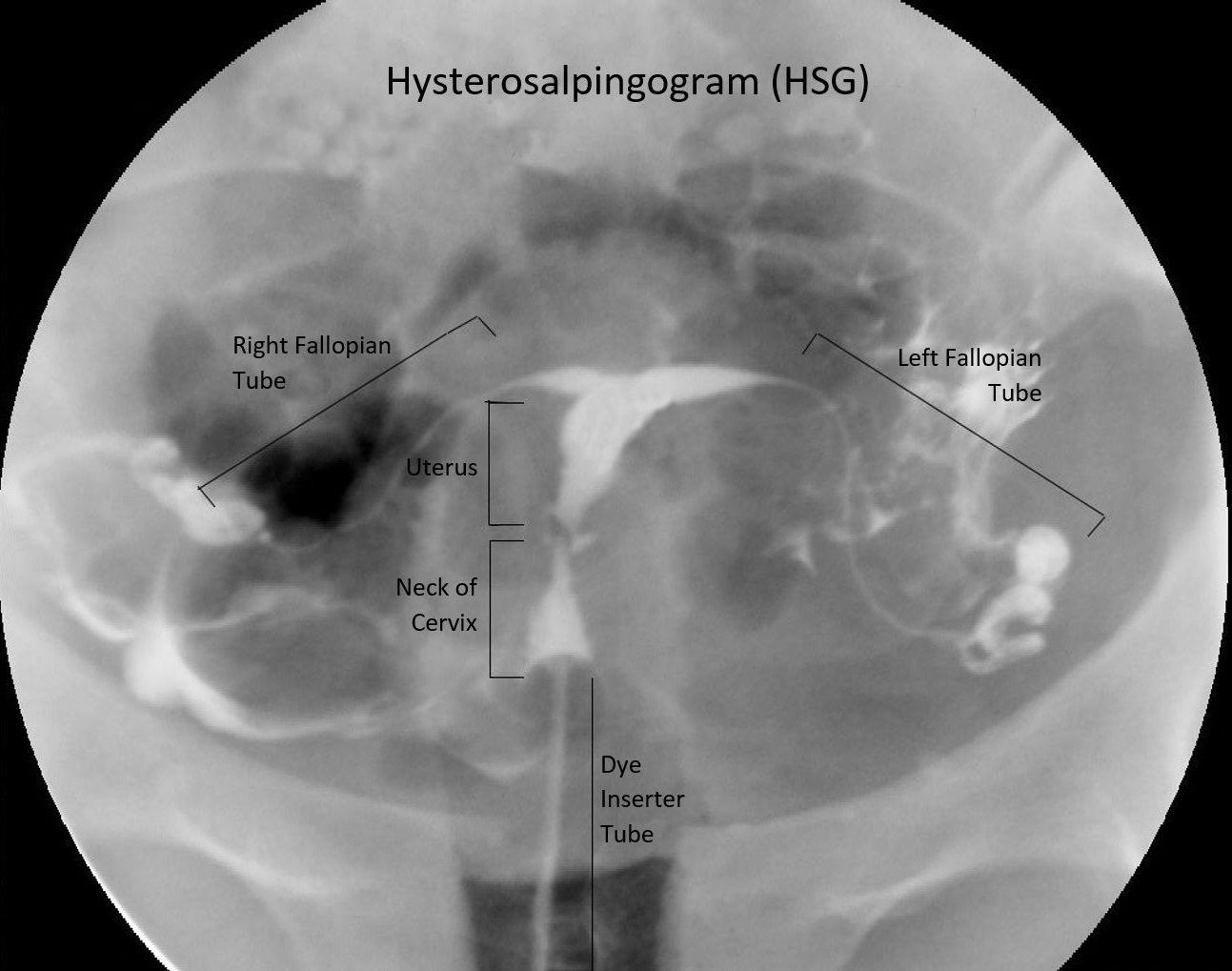 Die Hysterosalpingographie (HSG): Röntgenuntersuchung von Gebärmutter und Eileitern
