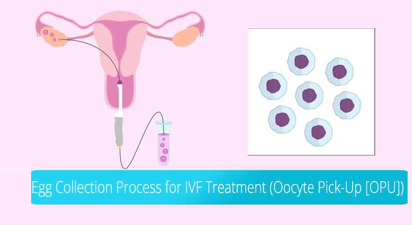 Die Eizellentnahme (Oocyte Pick-up, OPU) in der IVF-Behandlung