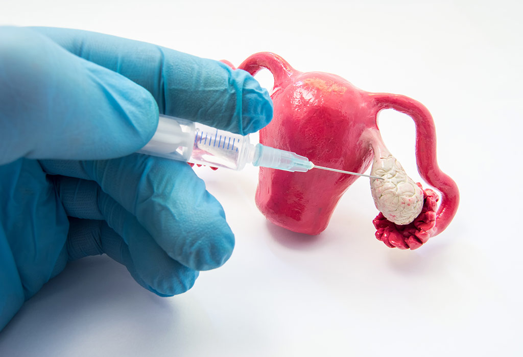 Ovarielles Hyperstimulationssyndrom (OHSS) – Überstimulation der Eierstöcke