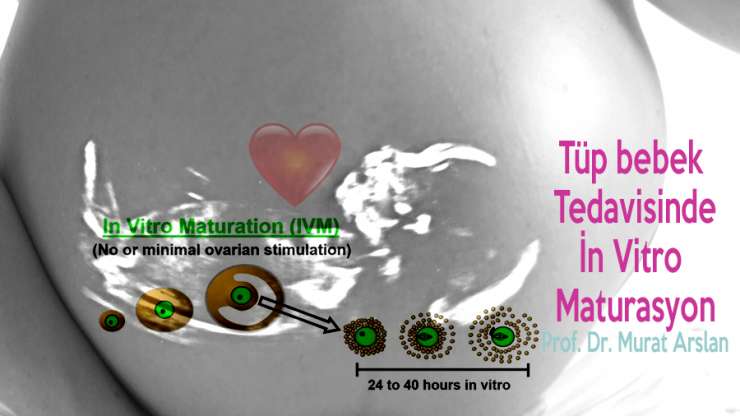 In-vitro-Maturation (IVM) in der Kinderwunschbehandlung