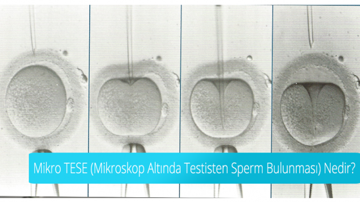 Was ist Mikro-TESE? Spermiengewinnung aus dem Hoden unter dem Mikroskop