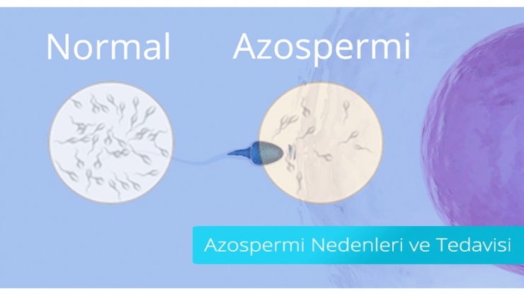 CAUSES AND TREATMENT OF AZOSPERMIA