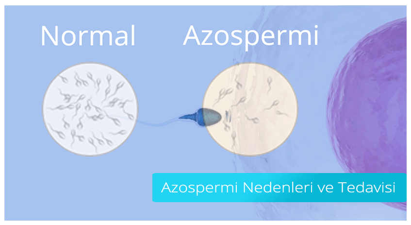 CAUSES AND TREATMENT OF AZOSPERMIA