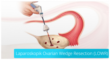 laparoscopic ovarian resection removing