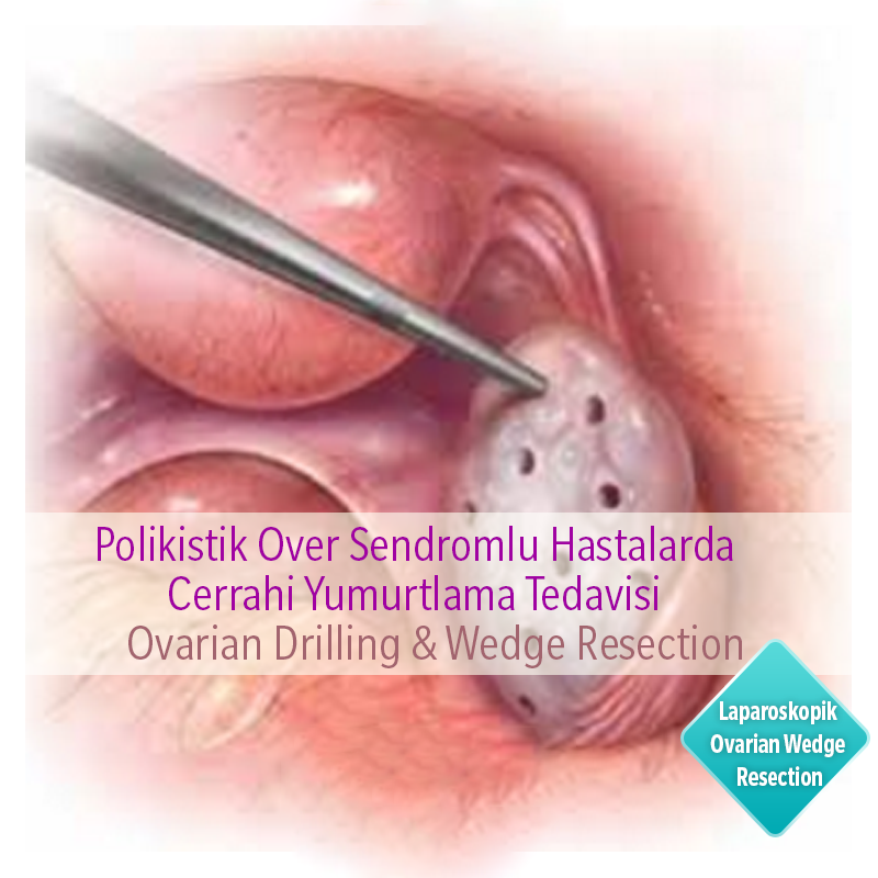 Surgical Ovulation Treatment in Patients with Polycystic Ovary Syndrome