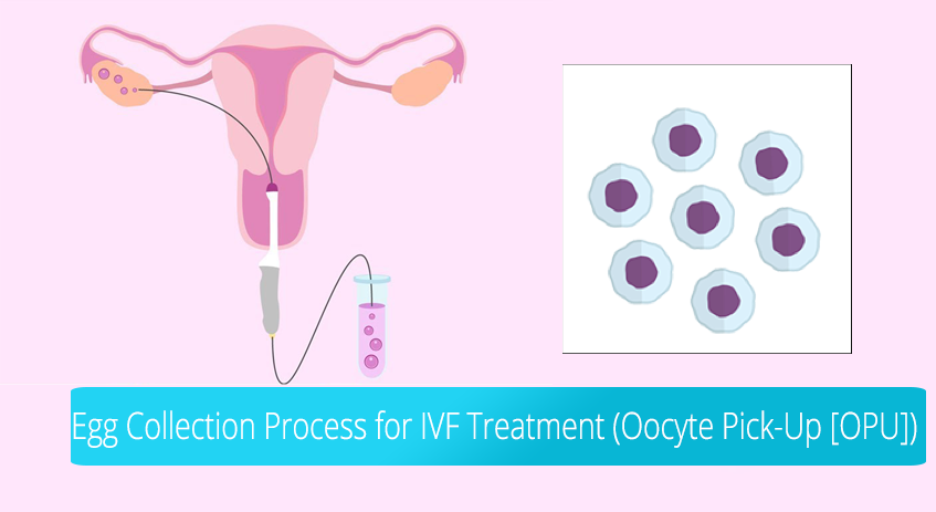 EGG COLLECTION PROCESS FOR IVF TREATMENT (OOCYTE PICK-UP [OPU])