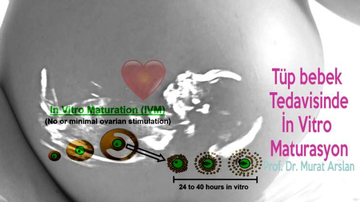 In vitro maturation in IVF Treatment