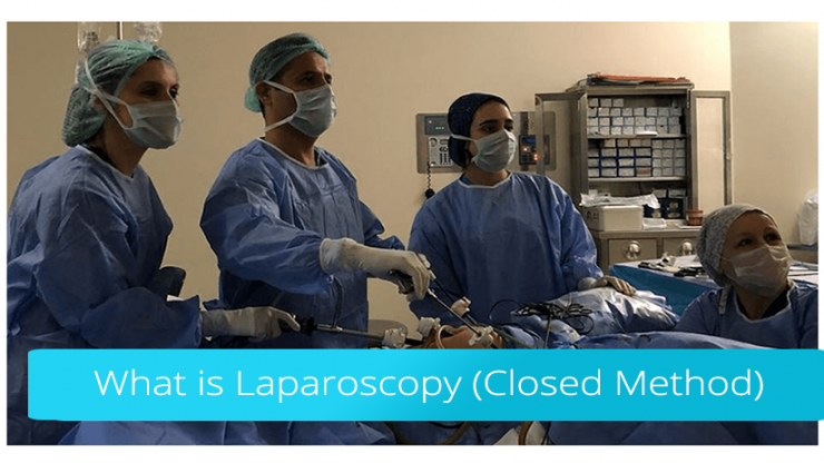 What is Laparoscopy (Closed Method)?