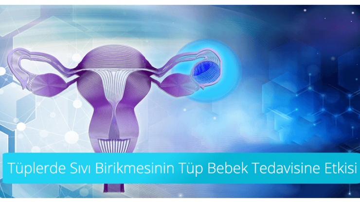 Tüplerde Sıvı Birikmesinin Tüp Bebek Tedavisine Etkisi