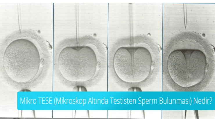 Что такое Micro TESE (обнаружение сперматозоидов из яичка под микроскопом)?