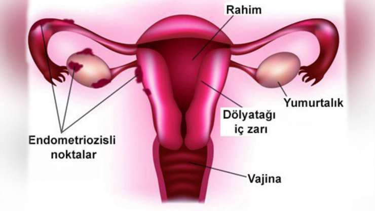 Kısırlığa Yol Açan Ciddi Bir Problem: Endometriozis Hastalığı