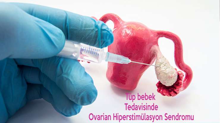 Ovarian Hiperstimülasyon Sendromu (OHSS) – Yumurtalıkların aşırı uyarılması