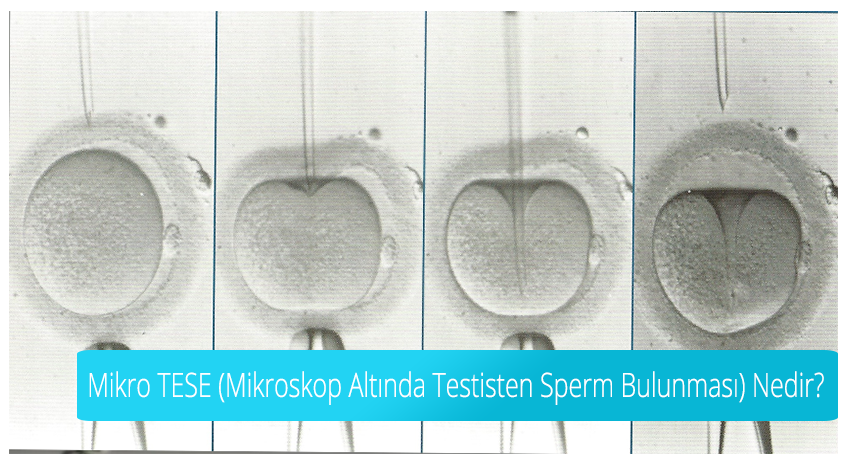 Mikro TESE (Mikroskop Altında Testisten Sperm Bulunması) Nedir?