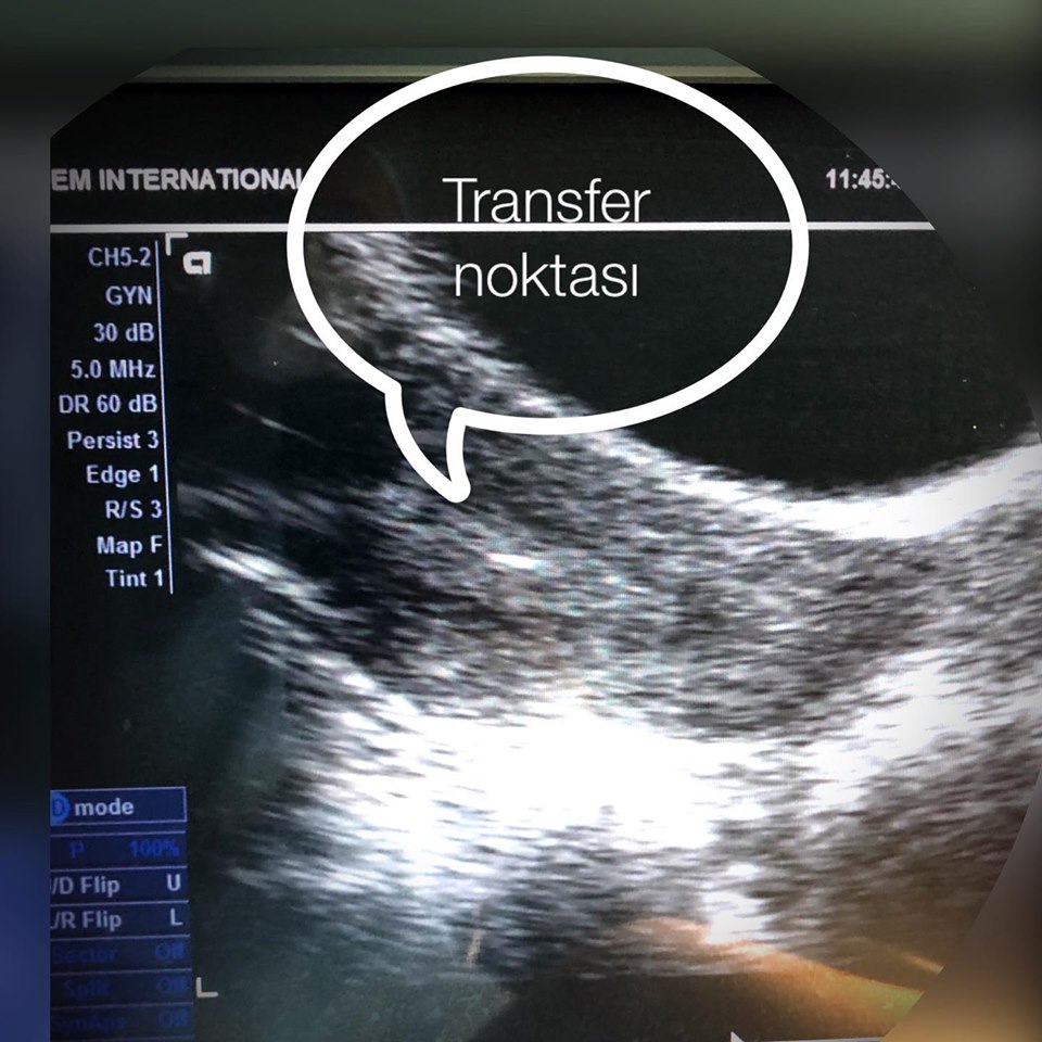 embriyo-transfer-noktasi