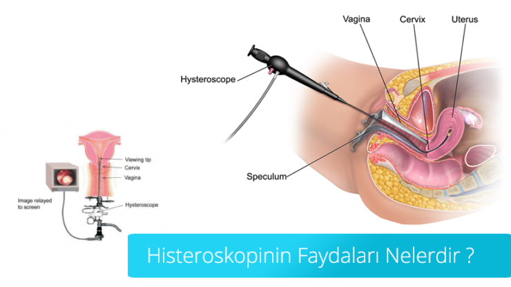 Histeroskopinin Faydaları Nelerdir ?